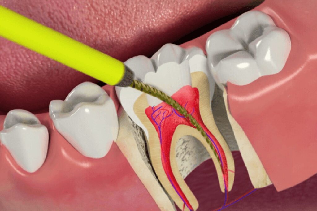 Perawatan Akar dan Saraf Gigi - Klinik Gigi SATU Dental