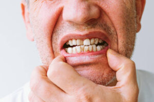 13 Penyakit Gigi dan Mulut yang Paling Umum Terjadi