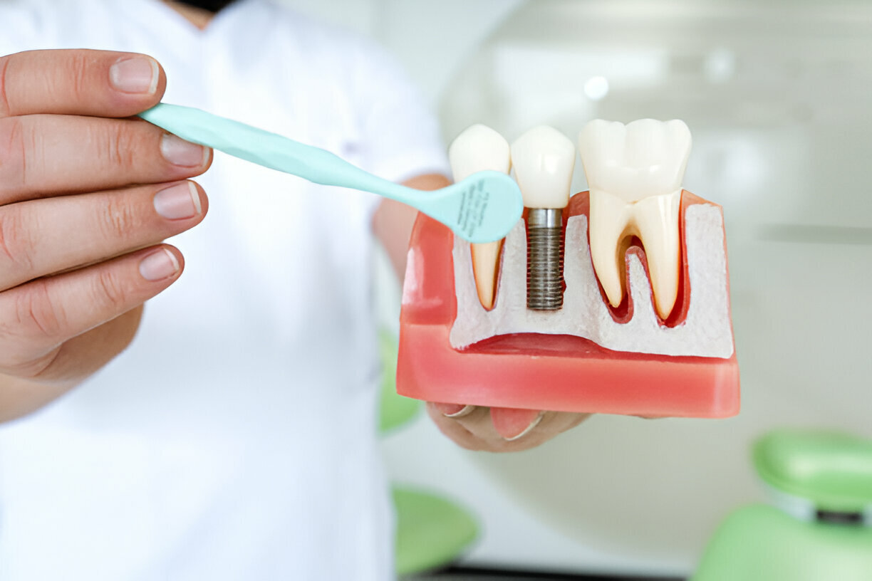 Implan Gigi Pengertian, Manfaat, Prosedur dan Cara Merawatnya