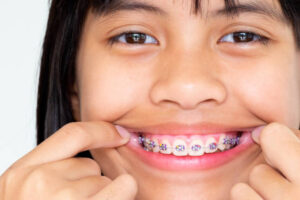 Kapan Kawat Gigi Anak Diperlukan? Ini Manfaat dan Prosedurnya