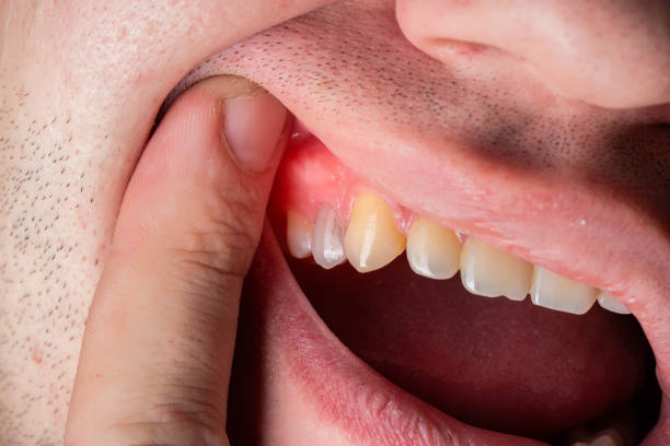 Penyebab Sakit Gigi Tak Kunjung Sembuh