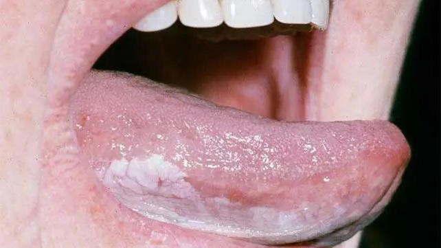 Leukoplakia