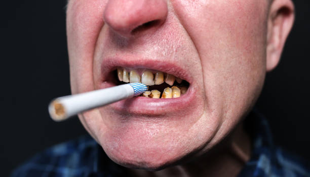 13 Bahaya Rokok Bagi Kesehatan Gigi dan Mulut