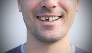 Penyebab Gigi Retak dan Cara Mengatasinya