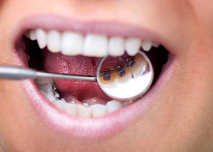 Behel Lingual (Lingual Braces)