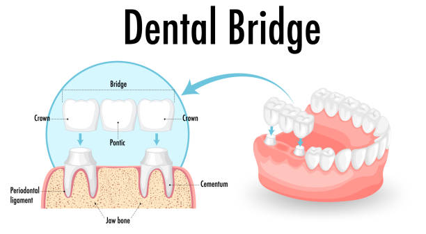 Apa Itu Dental Bridge