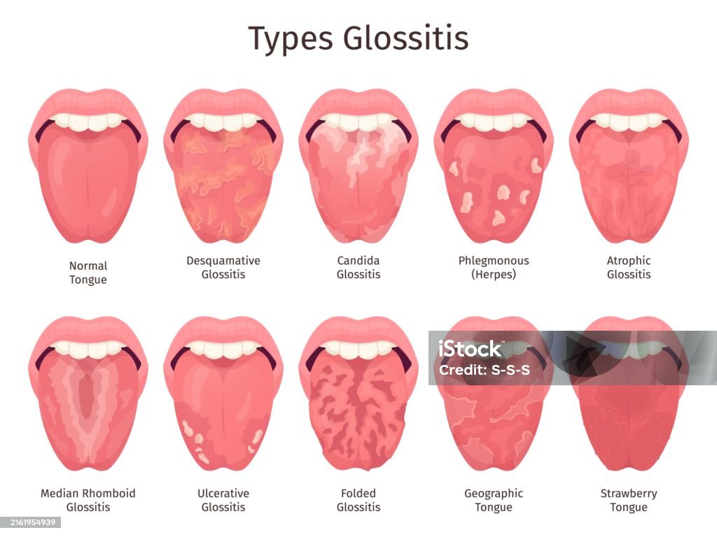 Jenis-Jenis Glositis