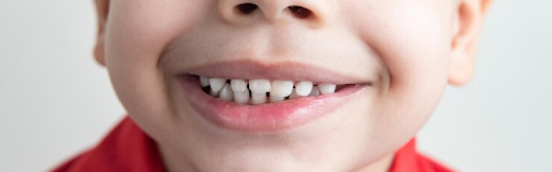 10 Penyebab Gigi Anak Keropos dan Cara Mencegahnya