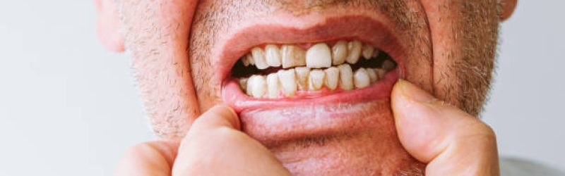13 Penyakit Gigi dan Mulut yang Paling Umum Terjadi