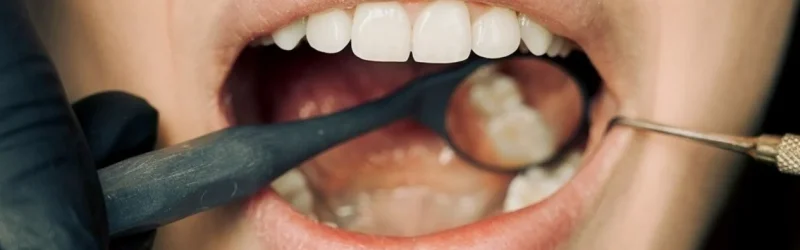 7 Kebiasaan Penyebab Gigi Rusak dan Cara Mengatasinya