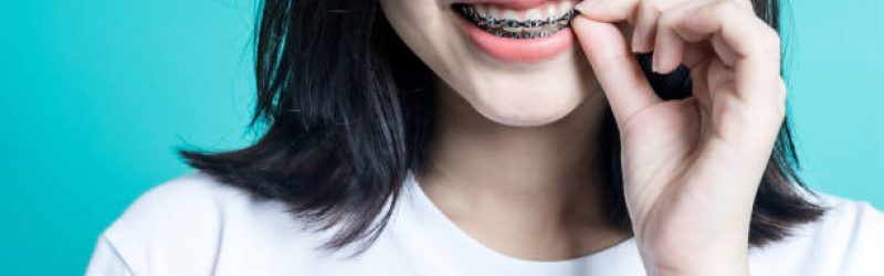 7 Resiko Menggunakan Behel Fashion dan Perbedaannya dengan Behel Perawatan