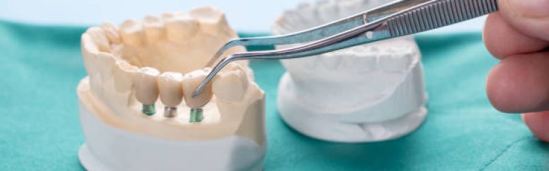 Dental Bridge: Biaya, Jenis, Manfaat dan Prosedur