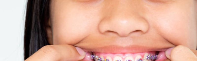 Kapan Kawat Gigi Anak Diperlukan? Ini Manfaat dan Prosedurnya