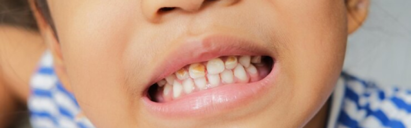 Karies Gigi pada Anak: Pengertian, Akibat, Penyebab dan Cara Mencegahnya