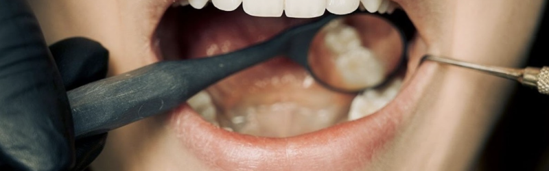 9 Cara Menghilangkan Karang Gigi dengan Mudah dan Efektif